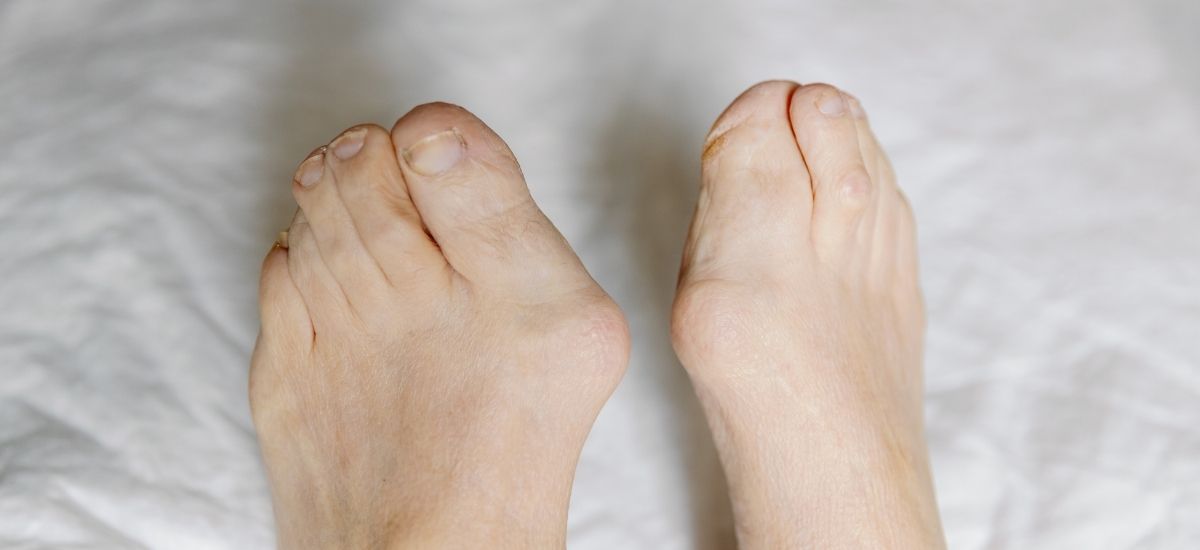 Hallux Valgus